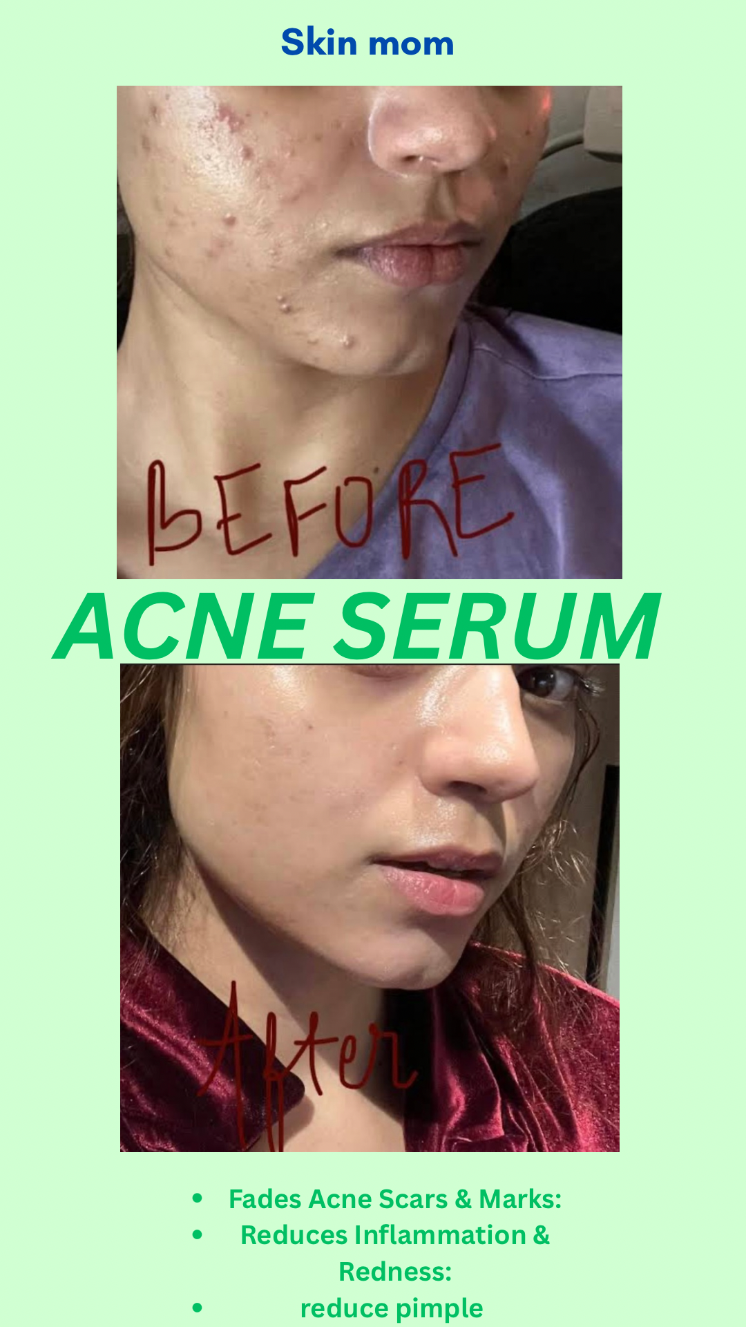 Acne calming serum 🌿